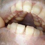 Pacu: a "piranha vegetariana" com dentes humanos